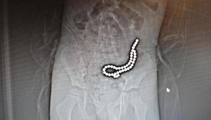 整整37颗！云南4岁孩子身体里取出……医生紧急提醒！